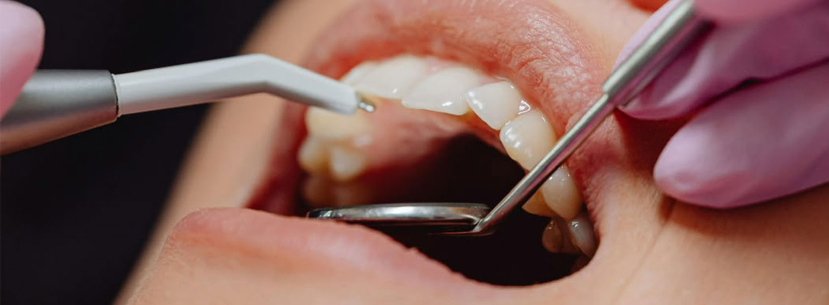 Diş Eti Tedavileri (Periodontoloji)