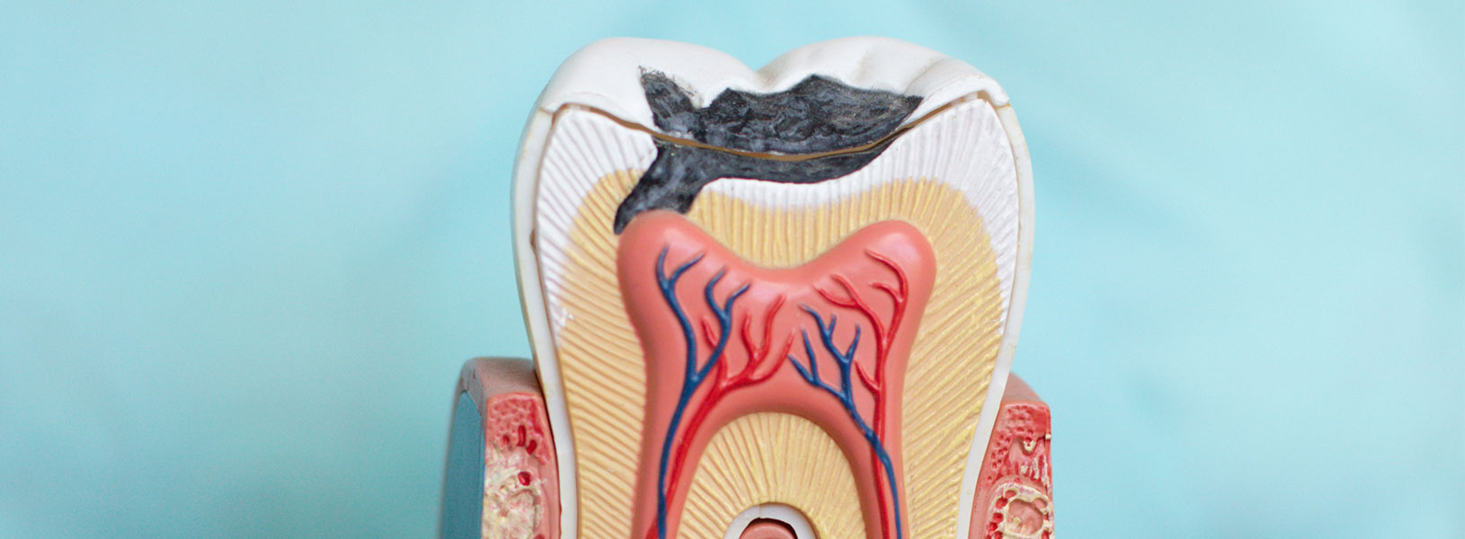 Kanal Tedavileri (Endodonti)